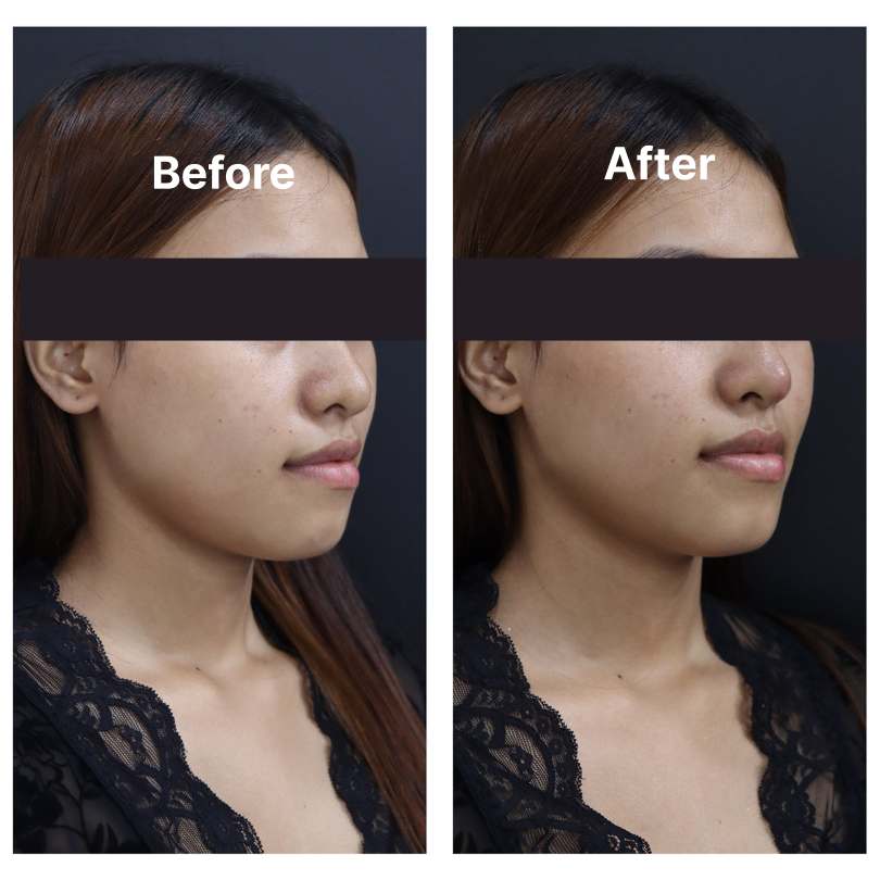 Fillers result KOQ10